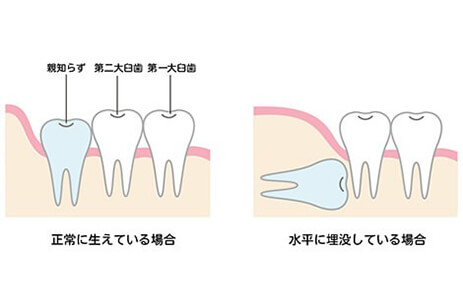 早く抜いた方が良いメリット